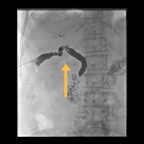 Percutaneous Cholangioscopy Johns Hopkins Medicine