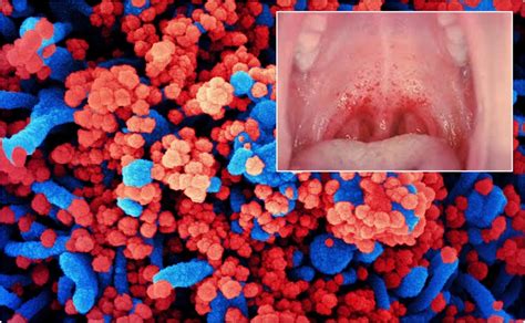 A New Sign Of COVID 19 A Rash In The Mouth