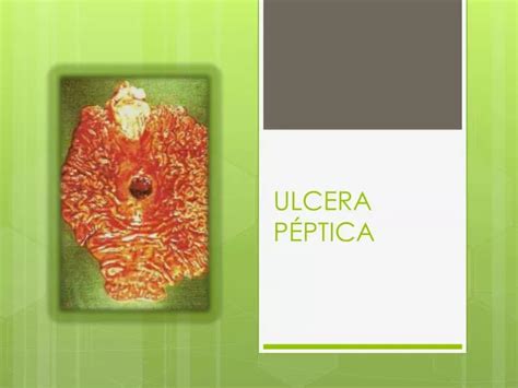 PPT ULCERA PÉPTICA PowerPoint Presentation free download ID 1898381