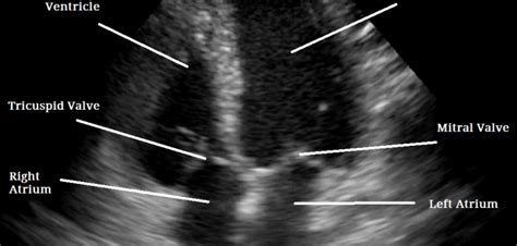 Stress Echocardiogram - Heart Sense