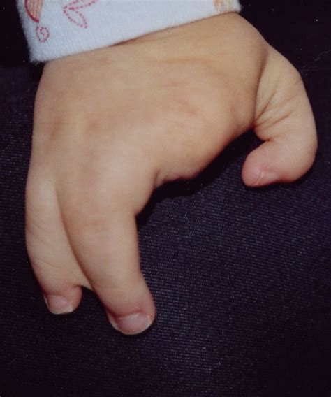 Ectrodactyly Syndrome