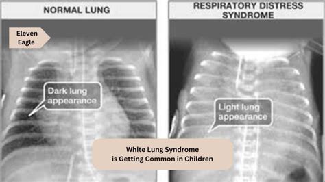 White Lung Syndromes What Is The White Lung Syndrome Symptoms And Remedies