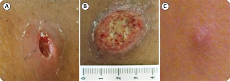 Cutaneous Leishmaniasis Early Stage