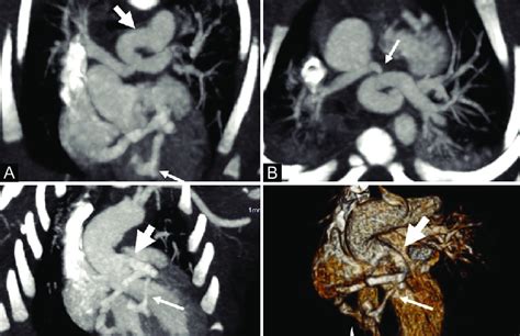 A D Coronal Axial Mip And Volume Rendering Image Of Mdct A Shows