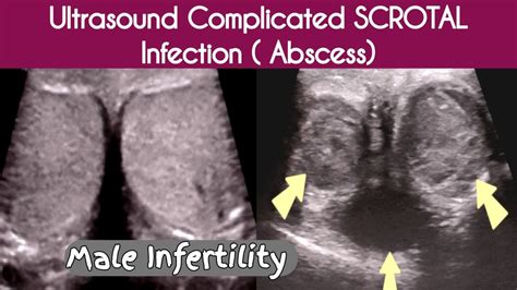 Complicated Scrotal Infection Abscess Ultrasound Male Infertility Youtube