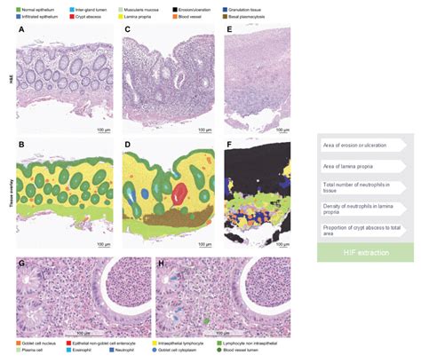 Revolutionizing Inflammatory Bowel… | College of American Pathologists