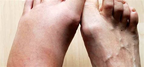 What Does A Bee Sting Look Like A Visual Guide Beehivehero