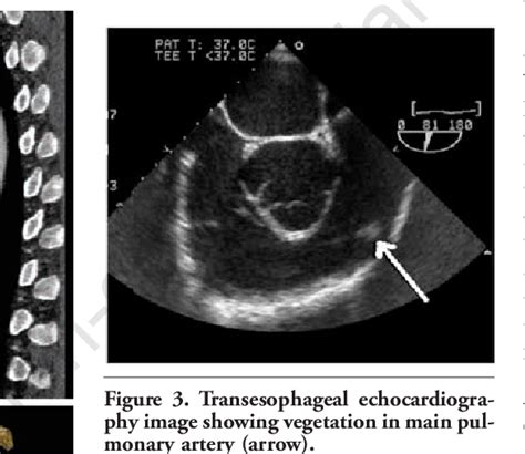 Figure 2 From Large Patent Ductus Arteriosus In An Adult Complicated By Pulmonary Endarteritis