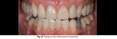 Before and After 2021: Smile Design 2.0 (Part 1) - Performing a smile makeover for dental ...