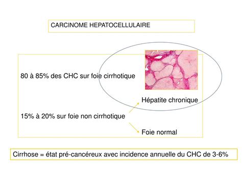 Ppt Carcinome H Patocellulaire Aspects Anatomopathologiques Amir