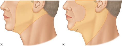 Secondary Facelift Irregularities And The Secondary Facelift Clinical