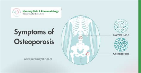 Symptoms Of Osteoporosis Quick Guide By Dr Anil Chauhan