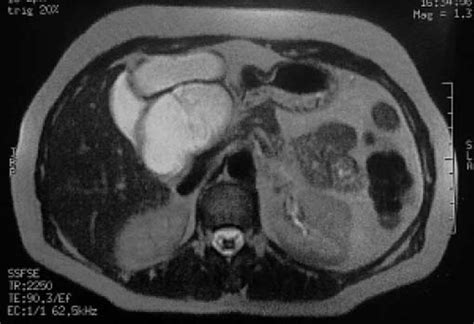 Rare Case Of Hepatic Endometriosis As An Incidental Finding Difficult