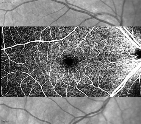 Heidelberg Oct Angiography Angio Oct