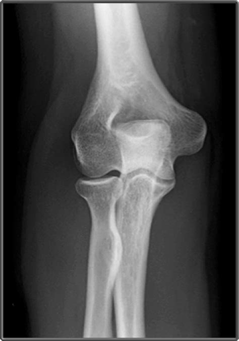 Clinical Anatomy Radiology Ap Elbow