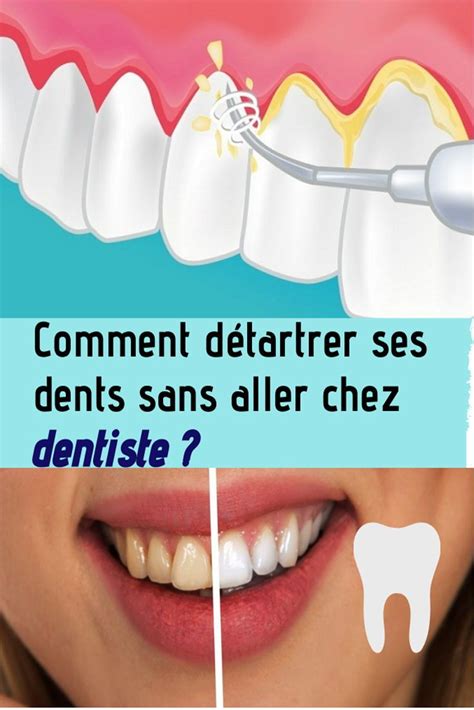 Comment détartrer ses dents sans aller chez dentiste Dentiste