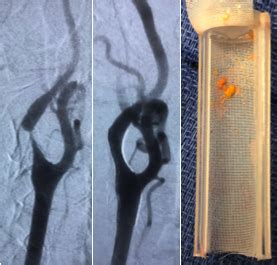 Transcarotid Artery Revascularization TCAR Reversing Flow To Move