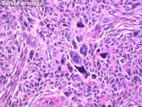 Adult Granulosa Cell Tumor Bizarre Nuclei