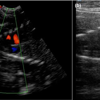 Colour Doppler Ultrasonography Of The Fetal Heart A And Fetal Aorta