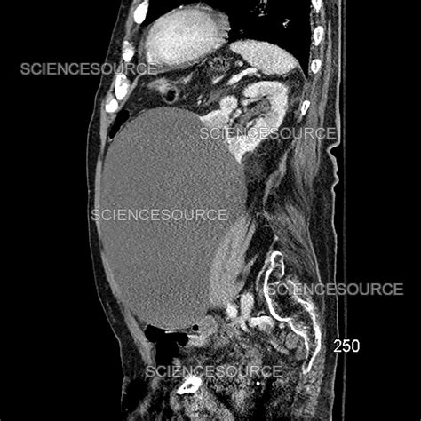 Giant Benign Renal Cyst Ct Stock Image Science Source Images