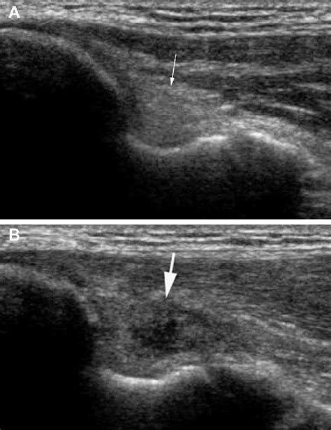 Medial Collateral Ligament Ultrasound