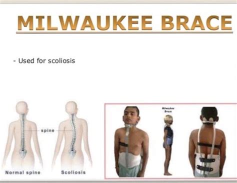 Milwaukee Brace Medizzy