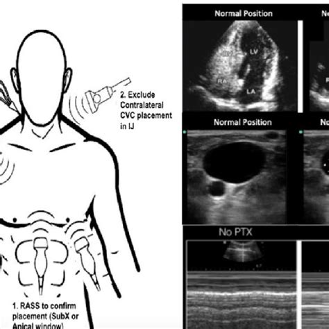 Point Of Care Ultrasound Guided Catheter Confirmation Protocol Image Download Scientific