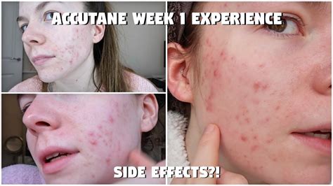 My Accutane Experience First Week Days On Isotretinoin Acne