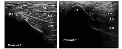 Adductor Muscles Ultrasound