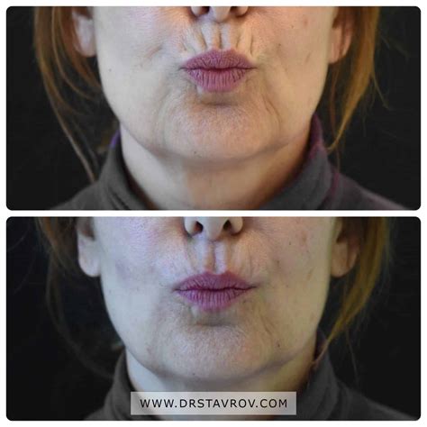 Пушачески бръчки. Цена - Dr. Stavrov Aesthetics в гр. София