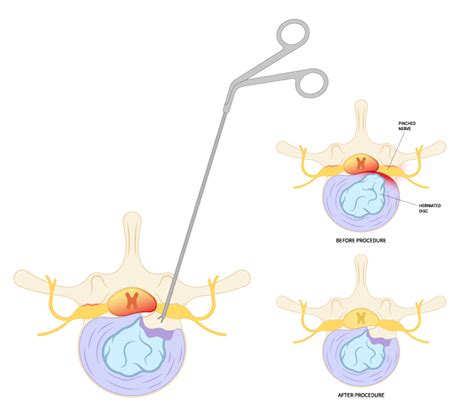 Lumbar Discectomy Specialists in Wichita - SpineMed Specialists