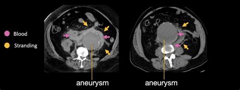 Abdominal CT Aortic Aneurysm LITFL Radiology Library