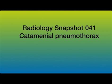 Catamenial Pneumothorax Youtube