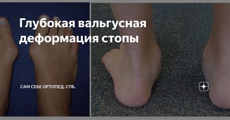 Глубокая вальгусная деформация стопы | Сам Себе Ортопед. Спб. | Дзен