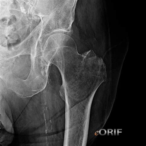 Greater Trochanter Hip Fracture S72 109A 820 20 EORIF