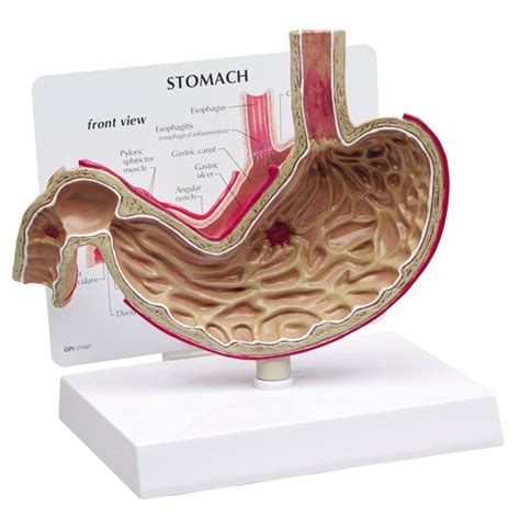 Stomach Anatomical Model Gastric Ulcer