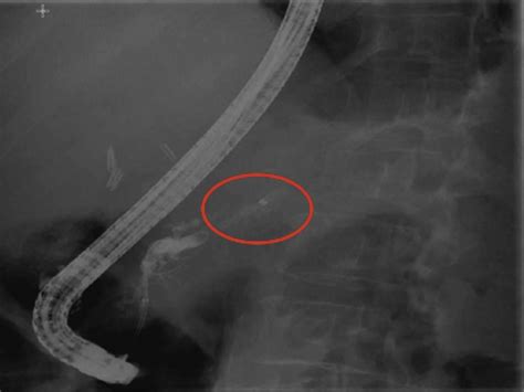 Pancreatoscopy Guided Laser Dissection And Ablation For Treatment Of Benign And Neoplastic