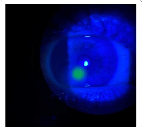 Anterior Segment Slit Lamp Examination Showing An Area Of Homogenous