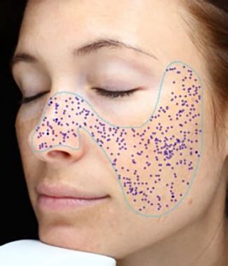 Key Areas Targeted By Visia Skin Analysis