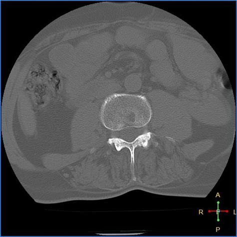 Ankylosing Spondylitis Image