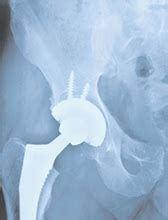 Biomet settles hip-replacement litigation - The Indiana Lawyer