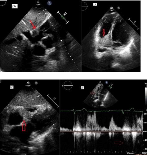 2A Subcostal view in 2D Echocardiography showing tumor mass attached to ...