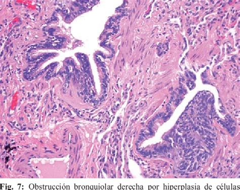 Figure 6 from Hiperplasia de células neuroendocrinas y tumorlets