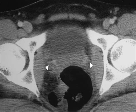 Ct Signs Of Urethral Injury Radiographics