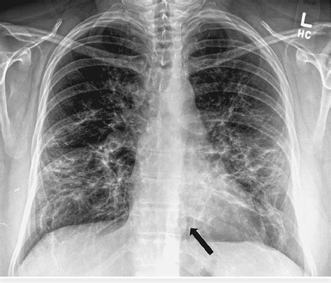 Chest X Ray Showing Worsening Of The Infiltrates With Pneumomediastinum