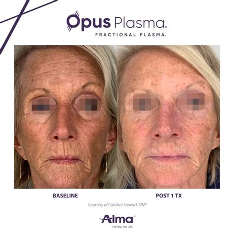 Opus Plasma Skin Tightening Gallery The Beauty Spot In Boulder Colorado