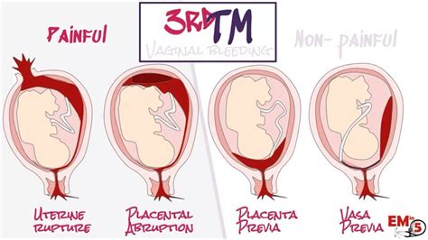 Aph Antepartum Haemorrhage Youtube