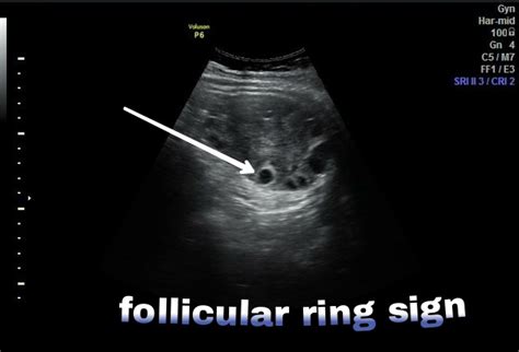 Ovarian Torsion Image Radiopaedia Org