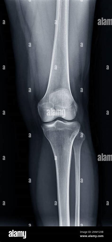 Film x-ray of Left knee joint AP view for diagnosis knee pain from ...