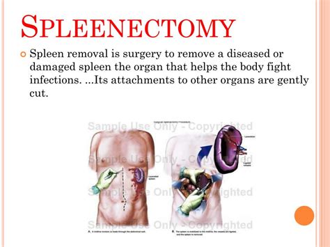 Ppt Spleen Powerpoint Presentation Free Download Id 5745023